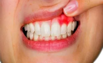 Dişeti hastalıkları sistemik hastalıkların belirtisi olabilir
