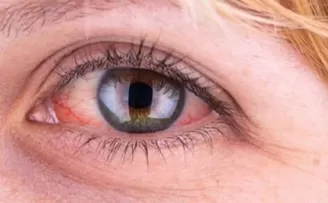 Yaz serinliği göz sağlığınızı tehdit etmesin: 6 koruyucu öneri